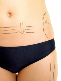 tummy tuck insurance denial