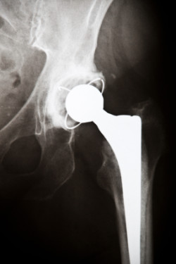 Stryker Metal Hip Implant Lawsuit