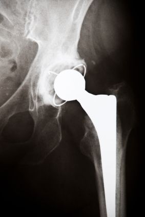 hip implants side effects class action lawsuit attorneys