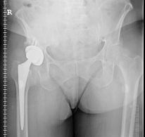Zimmer metal hip implant