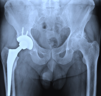 metal hip implant metal hip implant