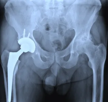 Zimmer hip implant lawsuit