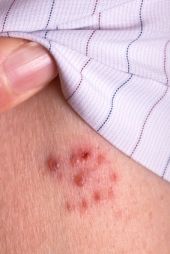 Zithromax SJS rash