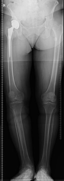 Zimmer metal on metal hip implant lawsuit attorney