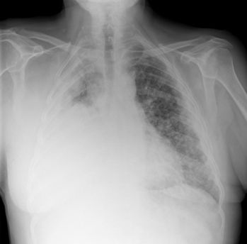 Types of Asbestos Mesothelioma