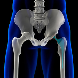 hip replacement implant
