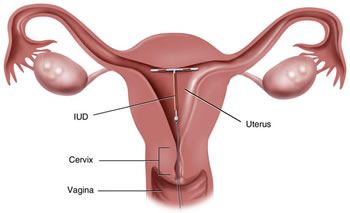 Mirena IUD Lawsuit