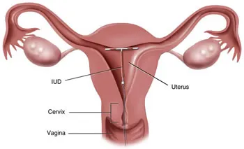 Mirena IUD Lawsuit