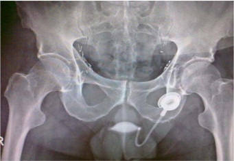 Mirena IUD embeded in uterus