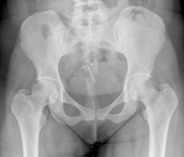 Mirena IUD Lawsuit
