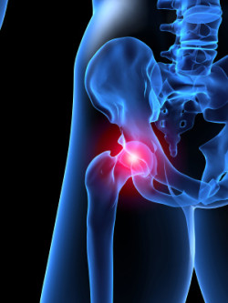Stryker hip implant lawsuit