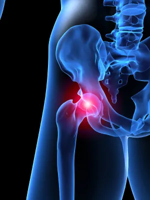 Stryker hip implant lawsuit