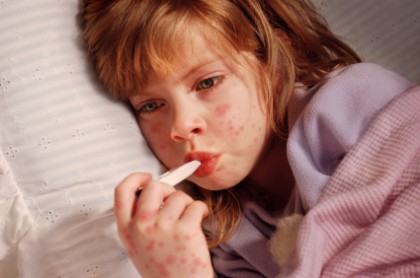 What is Stevens Johnson Syndrome?