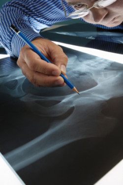 Stryker hip recall lawsuit
