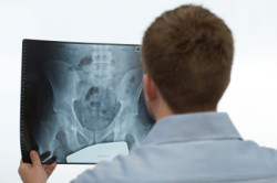 Metal Hip Implant Lawsuit