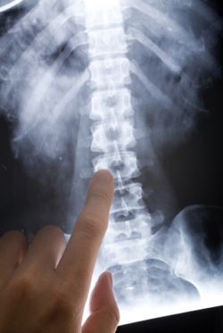 spine xray