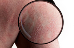 Stevens-Johnson Syndrome