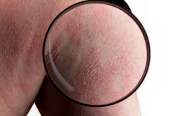 Stevens-Johnson Syndrome