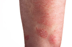 Stevens Johnson Syndrome