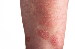 Stevens Johnson Syndrome