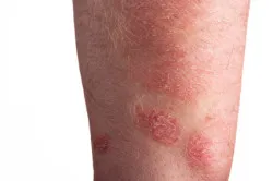 Stevens Johnson Syndrome