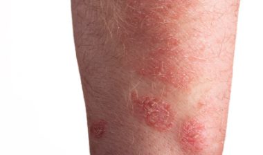 Stevens Johnson Syndrome