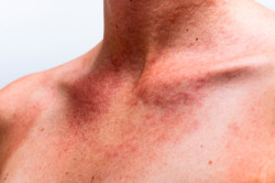 Sun allergy