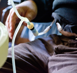 dialysis treatment