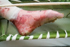 Toxic Epidermal Necrolysis