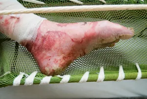 Toxic Epidermal Necrolysis