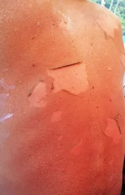 sjs-burn-rash