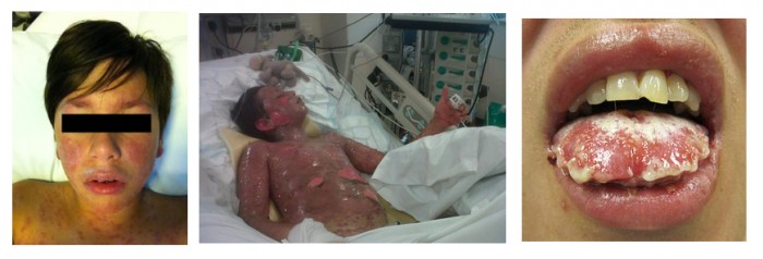 Stevens Johnson Syndrome Pictures