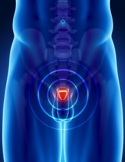 bladder cancer
