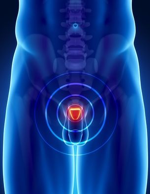 bladder cancer