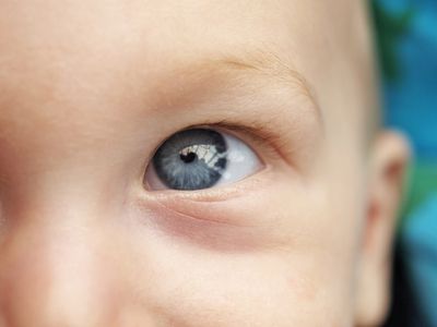 baby eye, baby blindness