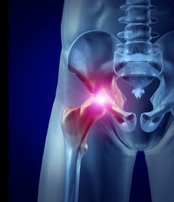 Hip Pain Xray