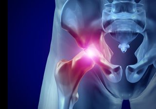 Hip Pain Xray