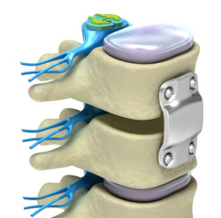 spinal fusion surgery