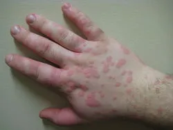 Erythema multiforme picture, SJS rash