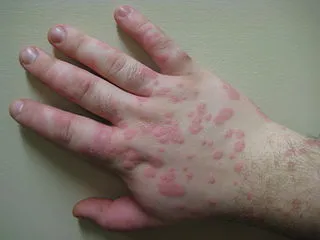 Erythema multiforme picture, SJS rash