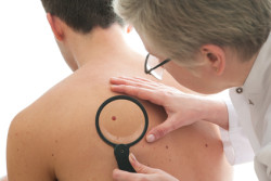 viagra melanoma skin cancer
