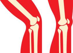 Blood-thinner-knee-replacement