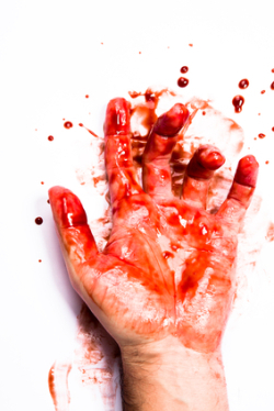 bleeding hand uncontrollable bleeding  Xarelto bleeding wrongful death