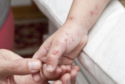 SJS SJS rash blisters rash