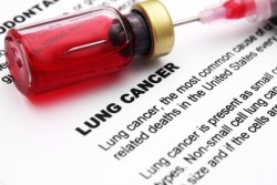 lung cancer asbestos lung cancer asbestos mesothelioma lung cancer asbestos
