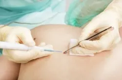 melanoma-removal-viagra