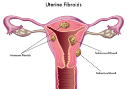 morcellation morcellator morcellation cancer uterine fibroid surgery 