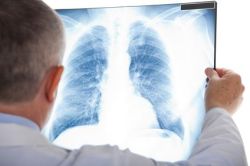 asbestos-lung-xray