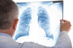 asbestos-lung-xray