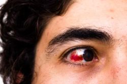  cipro-eye-damage